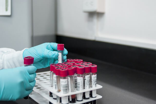 갑상선 기능 항진증 피 검사를 위한 혈액 샘플들