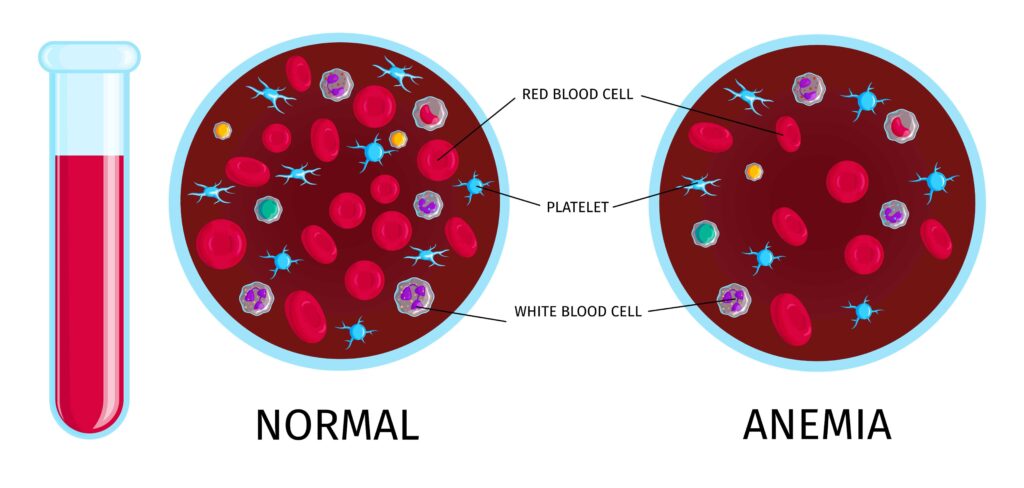 철 결핍 빈혈 치료를 해야 하는 이유
(적혈구의 수가 줄거나 적혈구 내의 Hb이 줄어들면 산소 전달 능력이 떨어진다.)