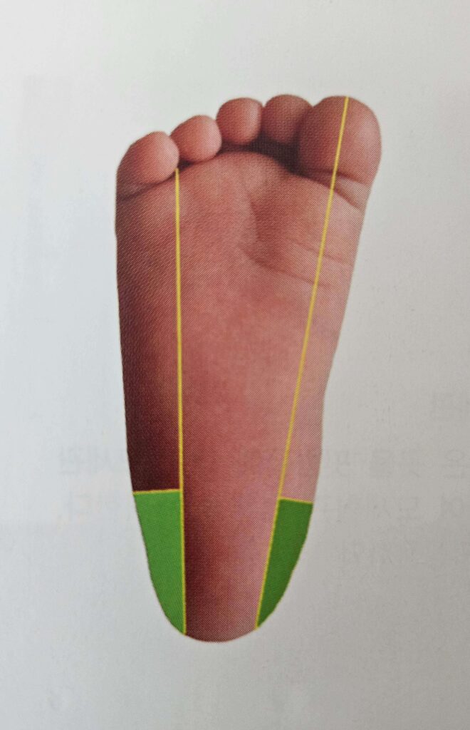모세혈관 채혈 - 발뒤꿈치 채혈