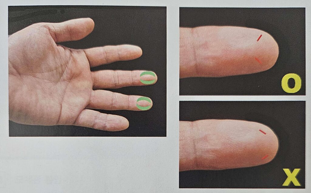 모세혈관 채혈 - 손가락 끝 채혈